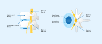 Degenerative Disc Disease | National Spine Health Foundation