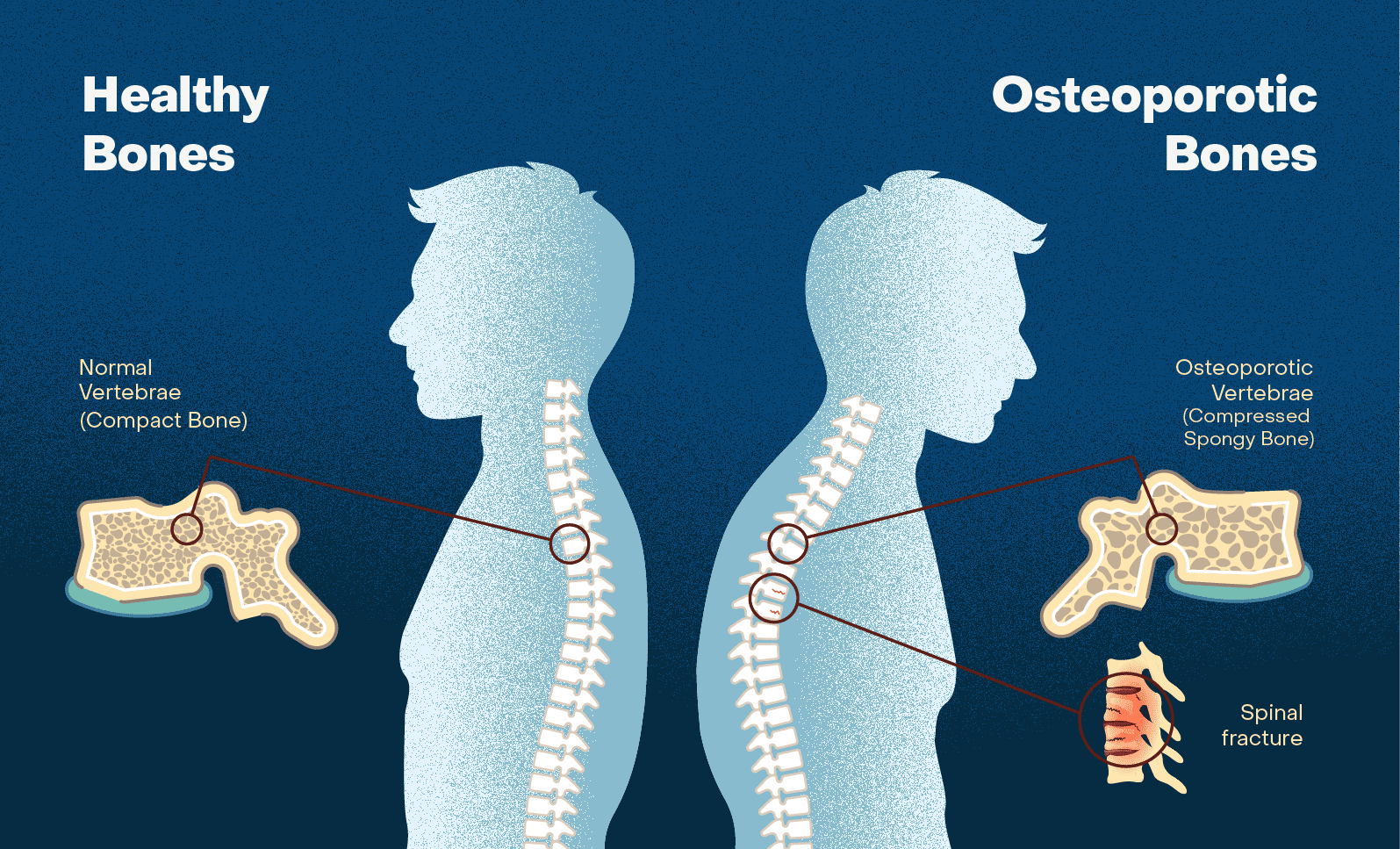 A description of the difference between healthy bones and bones with osteoporosis