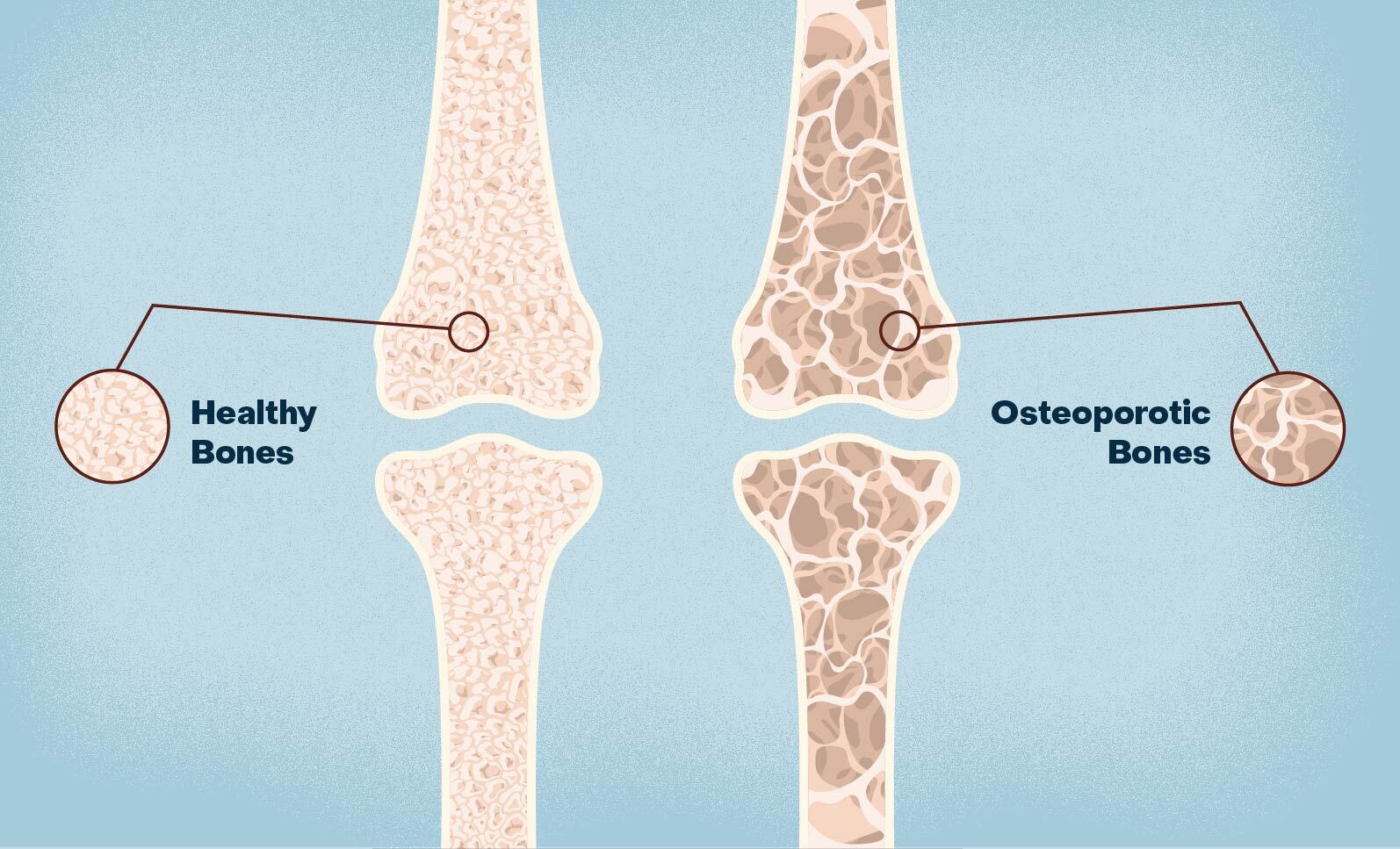 Osteoporosis And The Spine  National Spine Health Foundation